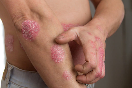 the man on the arm and abdomen spots psoriasis