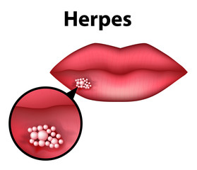 Herpes on the lip. Infographics. Vector illustration on isolated background.
