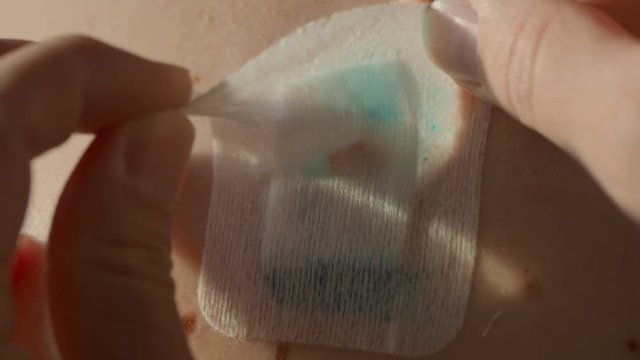 Peeling the patch on scar after removal of surgical sutures. Large nevus has been excised surgically with a scalpel. Preventive measure against skin cancer.