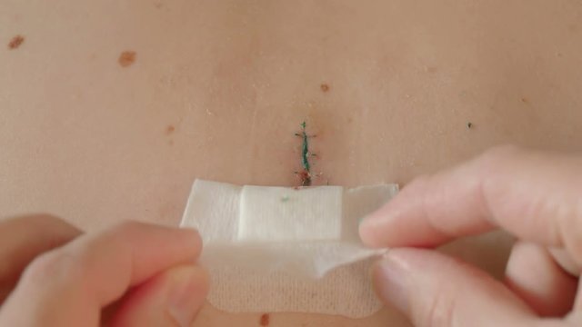 Peeling the patch on scar after removal of surgical sutures. Large nevus has been excised surgically with a scalpel. Preventive measure against skin cancer.