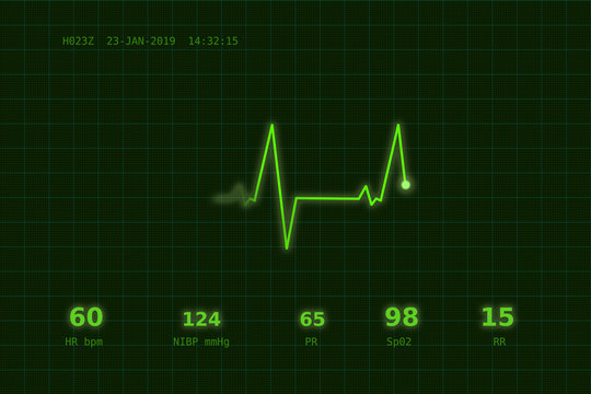 A graph of normal heartbeat on a green monitor