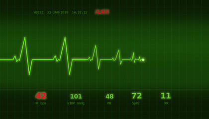 Graph of abnormal heartbeat on a green monitor with an ALARM signal