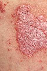 Psoriasis Vulgaris - detail of psoriatic skin disease, an autoimmune skin disorder is typically...
