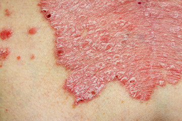 Psoriasis Vulgaris - detail of psoriatic skin disease, an autoimmune skin disorder is typically red, itchy, and scaly, macro with narrow focus