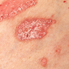 Fototapeta premium Psoriasis Vulgaris - detail of psoriatic skin disease, an autoimmune skin disorder is typically red, itchy, and scaly, macro with narrow focus