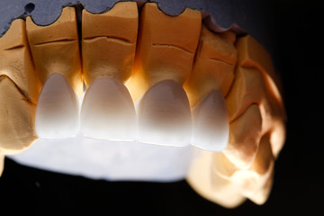 White front teeth veneers on diagnostic model on dark background. Close up.