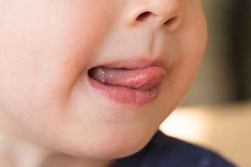 Close-up of child with aphtha or stomatits on mouth
