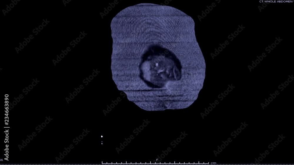 Poster ct scan of urinary system or ct urography coronal view on black background.