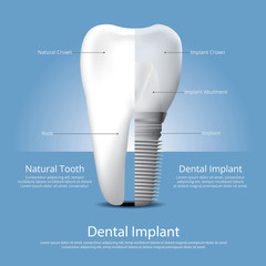 Human teeth and Dental implant Vector Illustration - obrazy, fototapety, plakaty