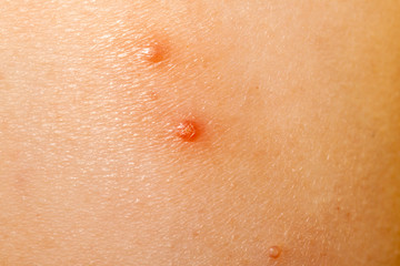 Close up of Molluscum Contagiosum also called water wart