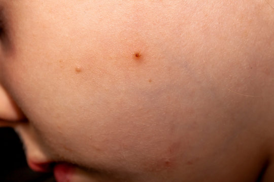 Close up of Molluscum Contagiosum also called water wart