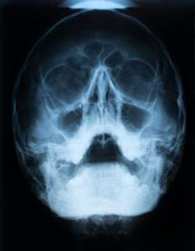 Xray film of a skull of a patient with paranasal sinus with acute right maxillary sinusitis with air fluid level