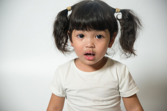 Close up Mucus flowing from nose of little Asian girl. child has a runny nose with clear snot,virus isolated on white background