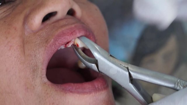 dental tooth extraction