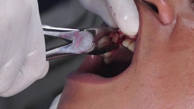 dental tooth extraction