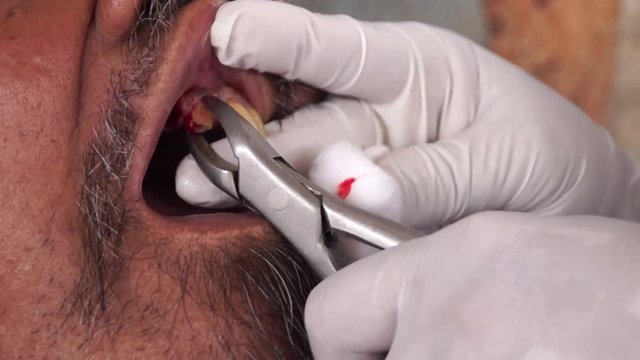 dental tooth extraction of male patient
