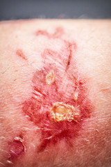 chemical burn on the skin from touching the plant 'burning Bush', Dictamnus