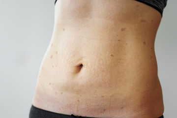Woman belly with lichen planus - obrazy, fototapety, plakaty