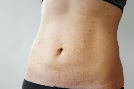 Woman belly with lichen planus