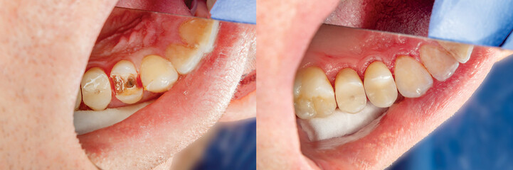 Human teeth close-up during restoration of filling. The concept of aesthetic dentistry