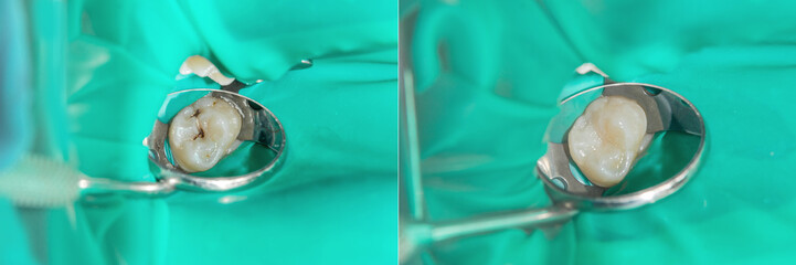 Teeth during treatment close-up in a dental clinic. Dental photopolymer composite filler.