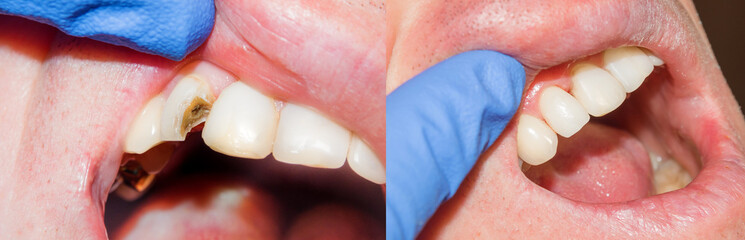 Teeth during treatment close-up in a dental clinic. Dental photopolymer composite filler.