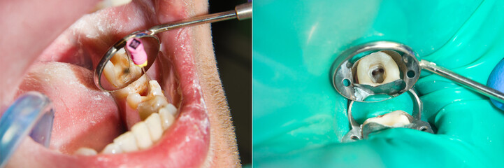 endodontic treatment of teeth close-up. Cleaning of the roots of the teeth and their filling. The concept of modern technology in the dental clinic - obrazy, fototapety, plakaty
