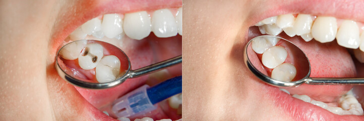 Teeth during treatment close-up in a dental clinic. Dental photopolymer composite filler.