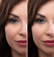 Woman's Face Before And After Cosmetic Procedure