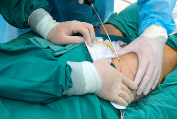Liposuction surgery in actual operating room.
