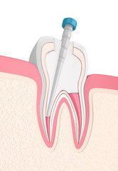 3d render of tooth with gutta percha, fiber post and filling