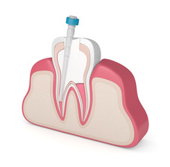 3d render of tooth with gutta percha, fiber post and filling