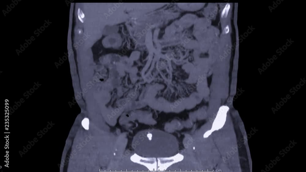 Poster ct scan of urinary system or ct urography coronal view on black background.