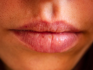 Fototapeta premium Beautiful female lips cracked from frost, wind, lack of vitamins. Lips need hygienic procedures