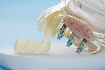 implant and orthodontic model for student to learning teaching model showing teeth.