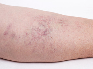 Vascular marks on the skin from varicose veins, vascular pattern on the skin, close-up, phlebeurysm, problem, white background