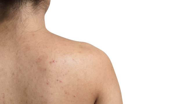 Young Asian woman have acne with red spots on the back isolated on white background, with clipping path.