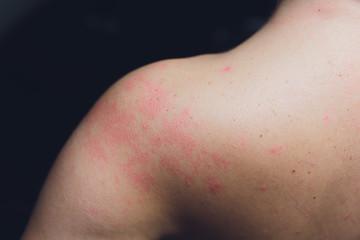 Close up Allergy rash, Around Back view of human with dermatitis problem of rash ,Allergy rash and...
