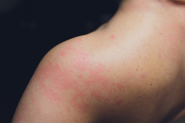 Close up Allergy rash, Around Back view of human with dermatitis problem of rash ,Allergy rash and...