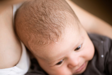 Seborrheic dermatitis on head in asian baby