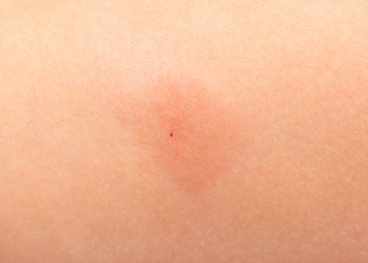 redness on the skin from vaccinations in a child