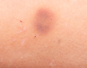 Fototapeta premium blue-yellow bruise on the arm
