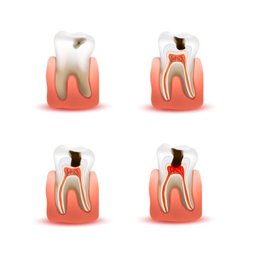 Set of human teeth with four different caries stages, infographic chart isolated on white