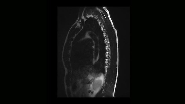Computed medical tomography MRI scan of the thoracic spine of a man with osteochondrosis