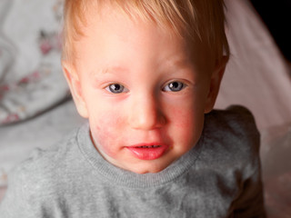 Little child with diathesis symptoms on cheeks, closeup. Surprised little baby boy with an allergic...