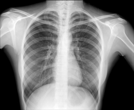 chest x-ray photo