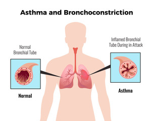 Asthma Medical Poster 