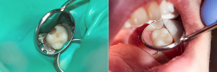 restoration of the tooth close-up. The concept of aesthetic treatment and dental filling