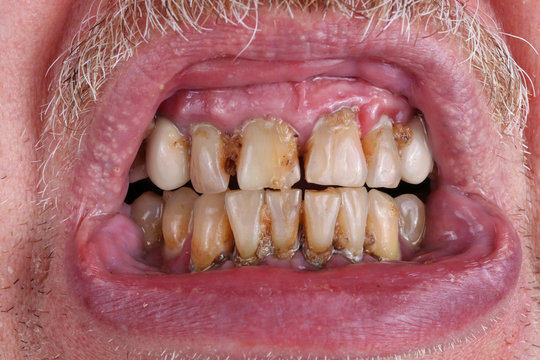 The teeth of an elderly man are spoiled by caries, tartar and poor waste  food macro