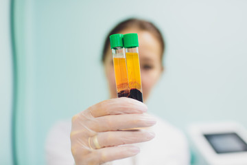 Preparing for Plasmolifting. Blood tubes in two layers divided by centrifuge after. cosmetic...